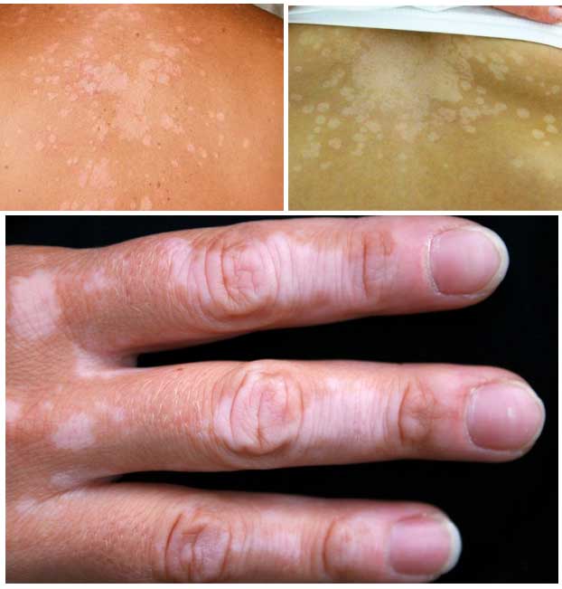 Thuần Mộc điều trị Lang ben Thuần Mộc điều trị Lang ben