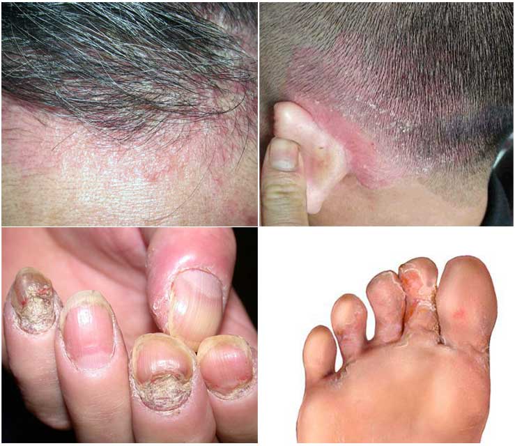 Thuần Mộc điều trị bệnh nấm da, nấm đầu Thuần Mộc điều trị bệnh nấm da, nấm đầu