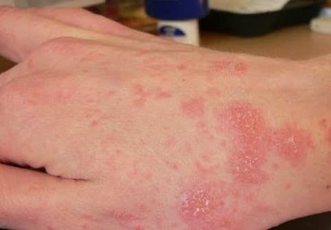 Thuần Mộc điều trị Viêm da cơ địa Thuần Mộc điều trị Viêm da cơ địa