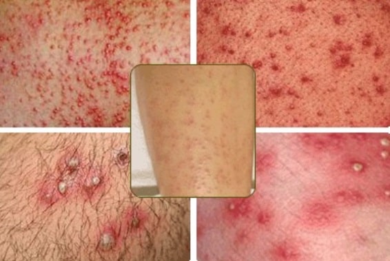 Thuần Mộc điều trị viêm lỗ chân lông, viêm nang lông Thuần Mộc điều trị viêm lỗ chân lông, viêm nang lông