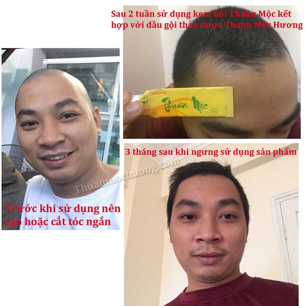điều trị dứt điểm nấm da đầu điều trị dứt điểm nấm da đầu
