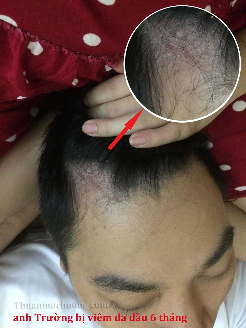 Nấm da đầu gây hói, rụng tóc | Nguyên nhân và cách điều trị - VIỆN CẤY TÓC  TỰ THÂN NEWHAIR BY KHƠ THỊ