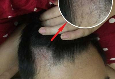 điều trị bệnh bị nấm da đầu
