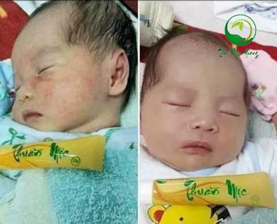 điều trị hăm da chàm sữa bằng kem thuần mộc