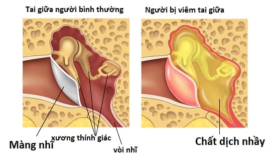 viêm tai giữa