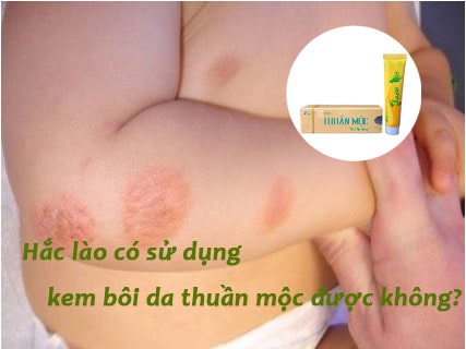 hắc lào sử dụng kem bôi da thuần mộc được không