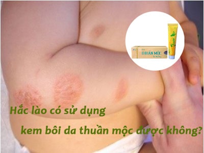 hắc lào sử dụng kem bôi da thuần mộc được không