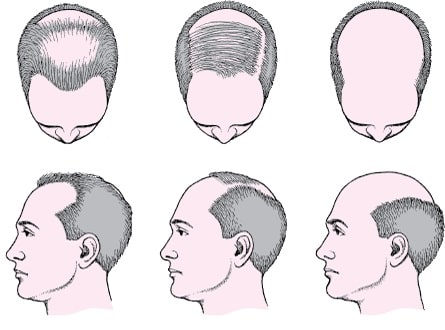 hói đầu nam di truyền